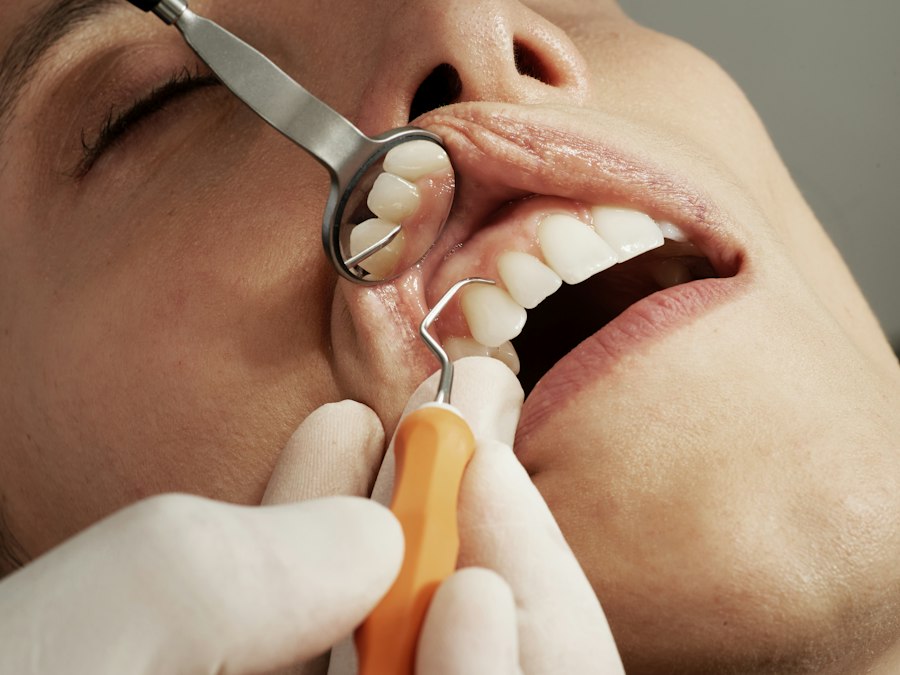 Dental Fillings